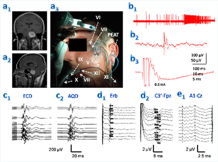 Neuro Oncología - Monitotrización neurofisiológica intraoperatoria con EMG